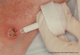 Intrasite Jel 25 g Debritman Jeli, intrasite gel