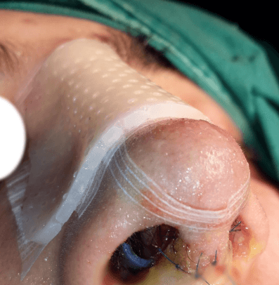 Termoplastik Burun Ateli - Rinoplasti Ateli - External Nazal Splint