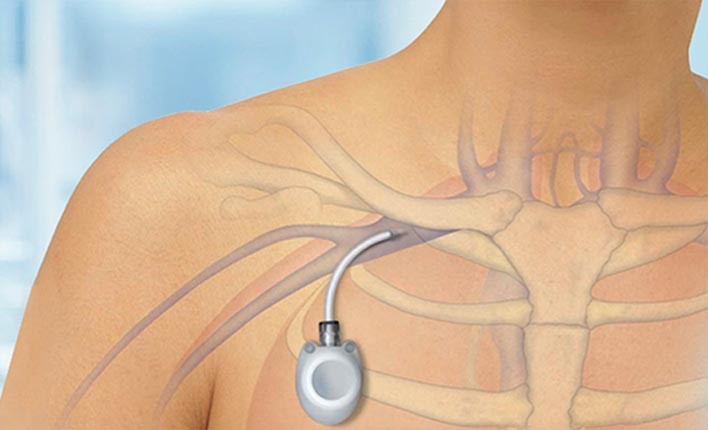 Kemoterapi Port Katateri Celsite ST301 8.5 f Mbs/Venous