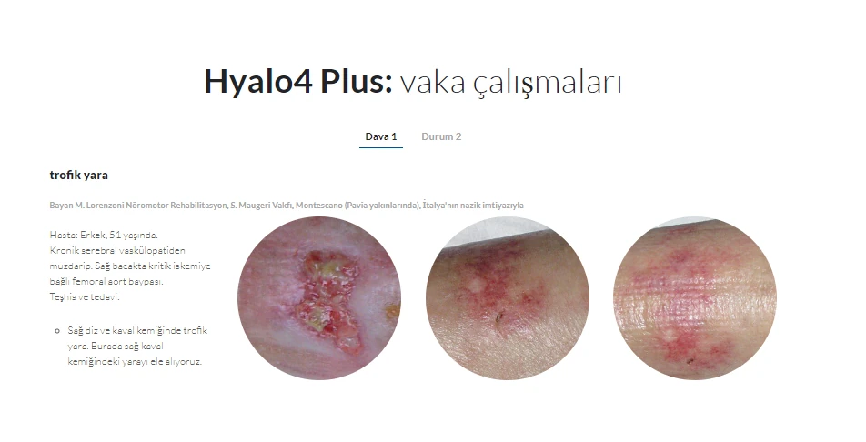 Hyalo4 Plus Hyaluronik Asit %0,2 + Gümüş Sülfadiazin %1 25 g