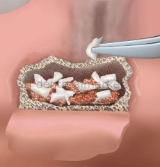 Biopad Collagen Sünger Kompres - Kolajen Ped Birim Maliyettir