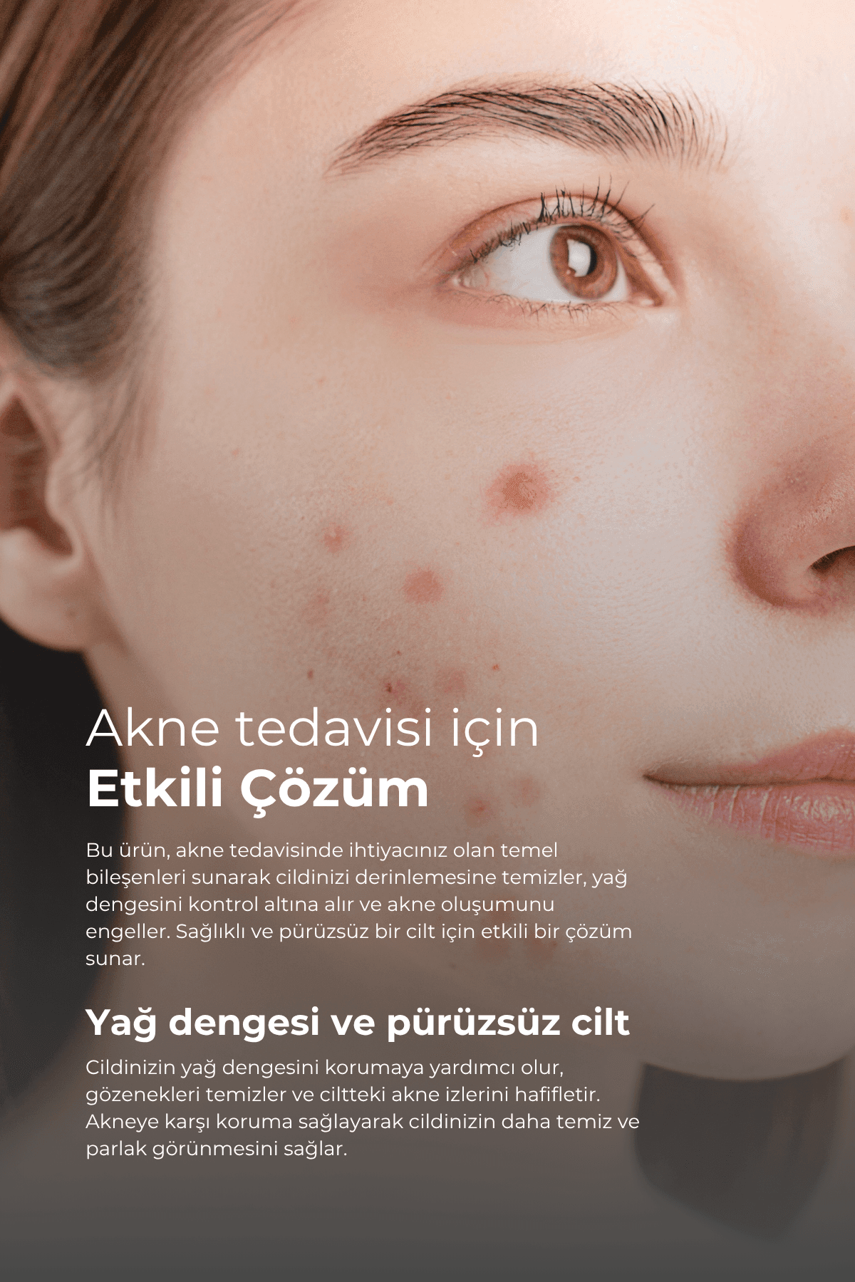 Akne ve Rozasea Bakım Seti (Temizleme Jeli Dermodicos Plus)