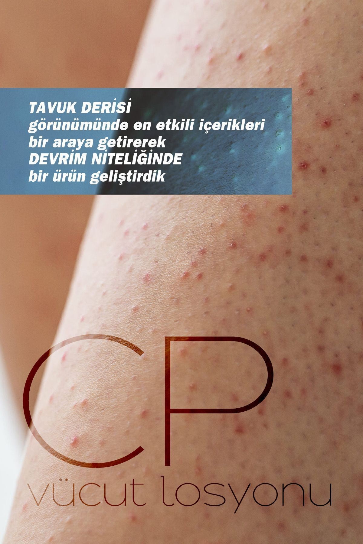 TTO Vücut Losyonu Cp 200ml Keratosis Pilaris Ve Batık (Tavuk Derisi Görümüne Karşı)