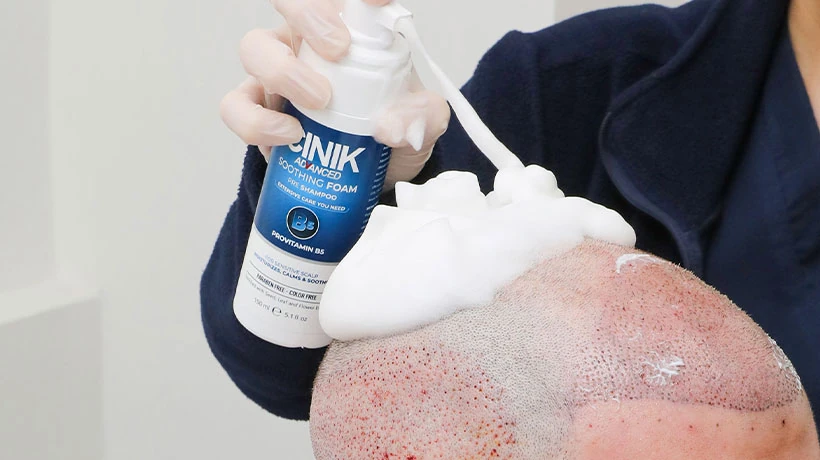 How to Care For Your Hair after a Hair Transplant?