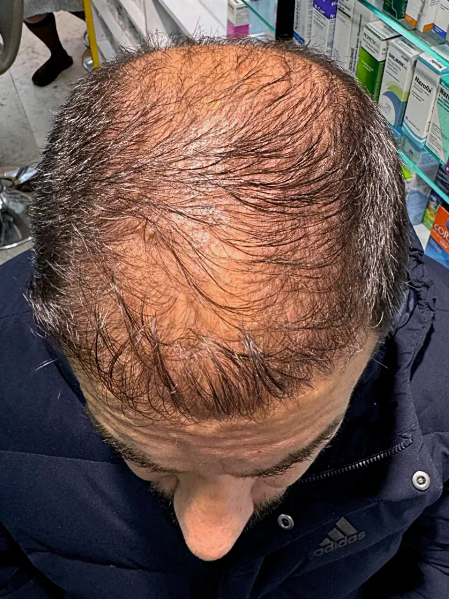 Ürün kullanımı öncesi saç görünümü