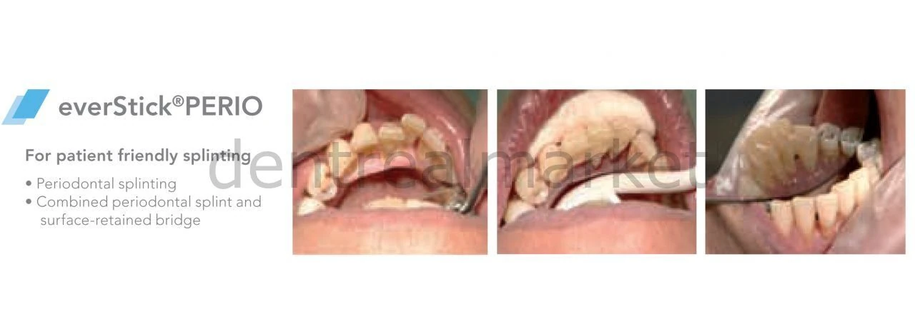 EverStick PERIO 2*12 cm - Fiber Takviyeli Periodontal Splintleme