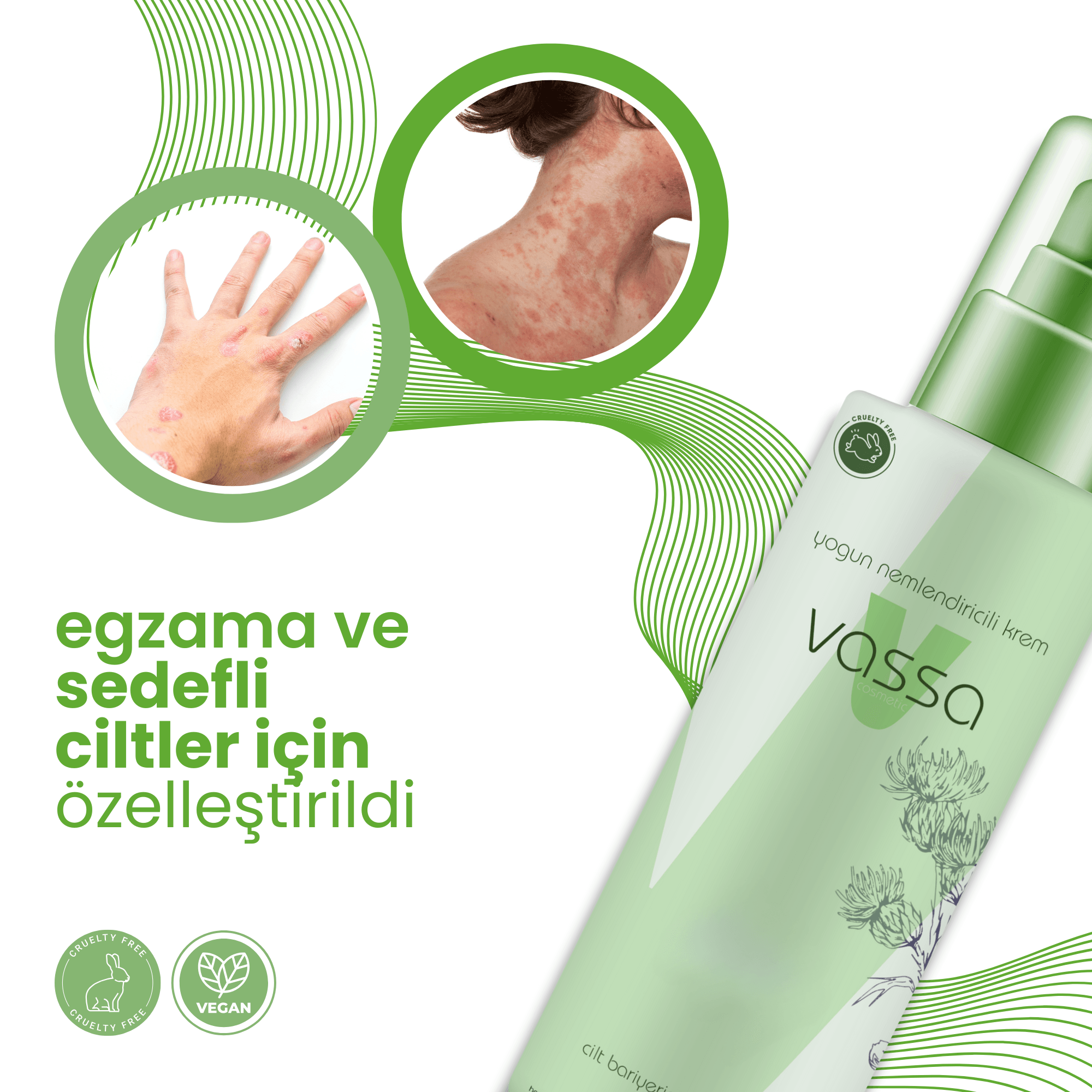 Vassa Akne, Sedef, Sivilce, & Yanık Yaraları Için Önleyici Yoğun Nemlendirici Krem - 150ml