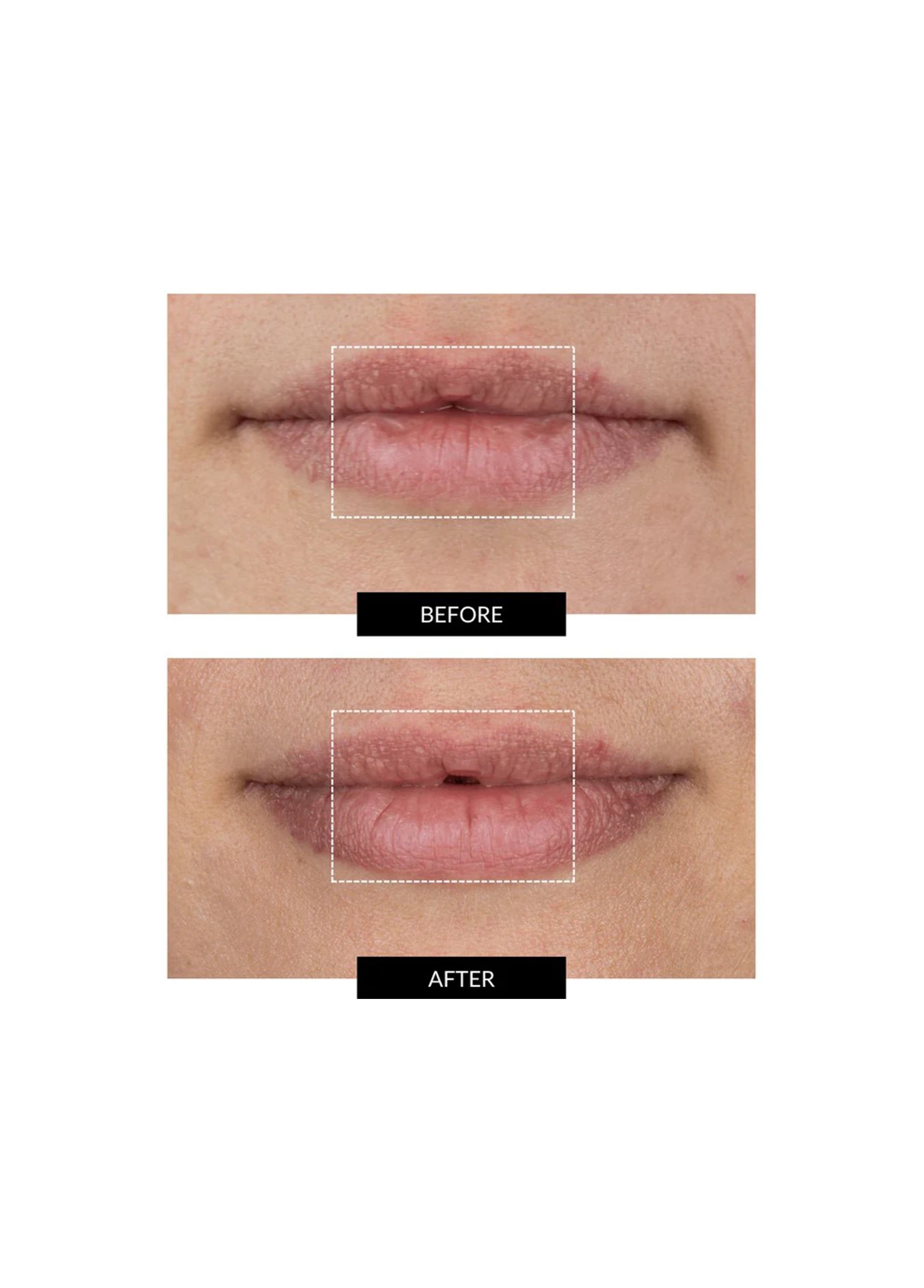 LED Kırışıklık Karşıtı Dudak Çevresi Bakım Cihazı