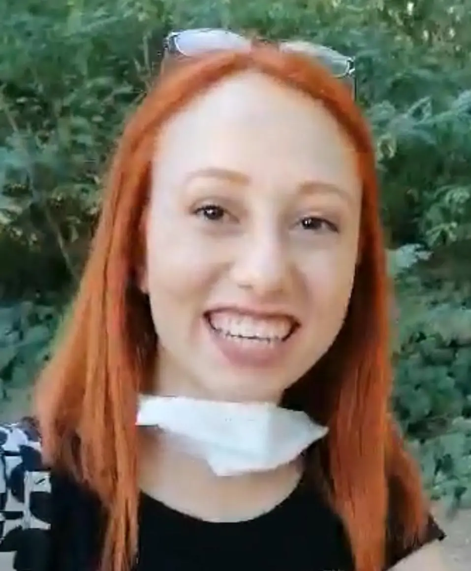 &nbsp;Bu fotoğrafta göz kapaklarımda belirgin bir düşüklük ve özellikle sol tarafta derin bir asimetri görülüyor. Burnum ödem nedeniyle yüzüme göre daha şekilsiz ve büyük görünüyor. Gülümsediğimde dudaklarım çizgi şeklini aldığı için üst dudağım neredeyse görünmüyor.
Bu fotoğraf çekildiğinde yalnızca 24–25 yaşlarında olmama rağmen yüz ifadem olduğundan daha yorgun görünüyordu.&nbsp;&nbsp;