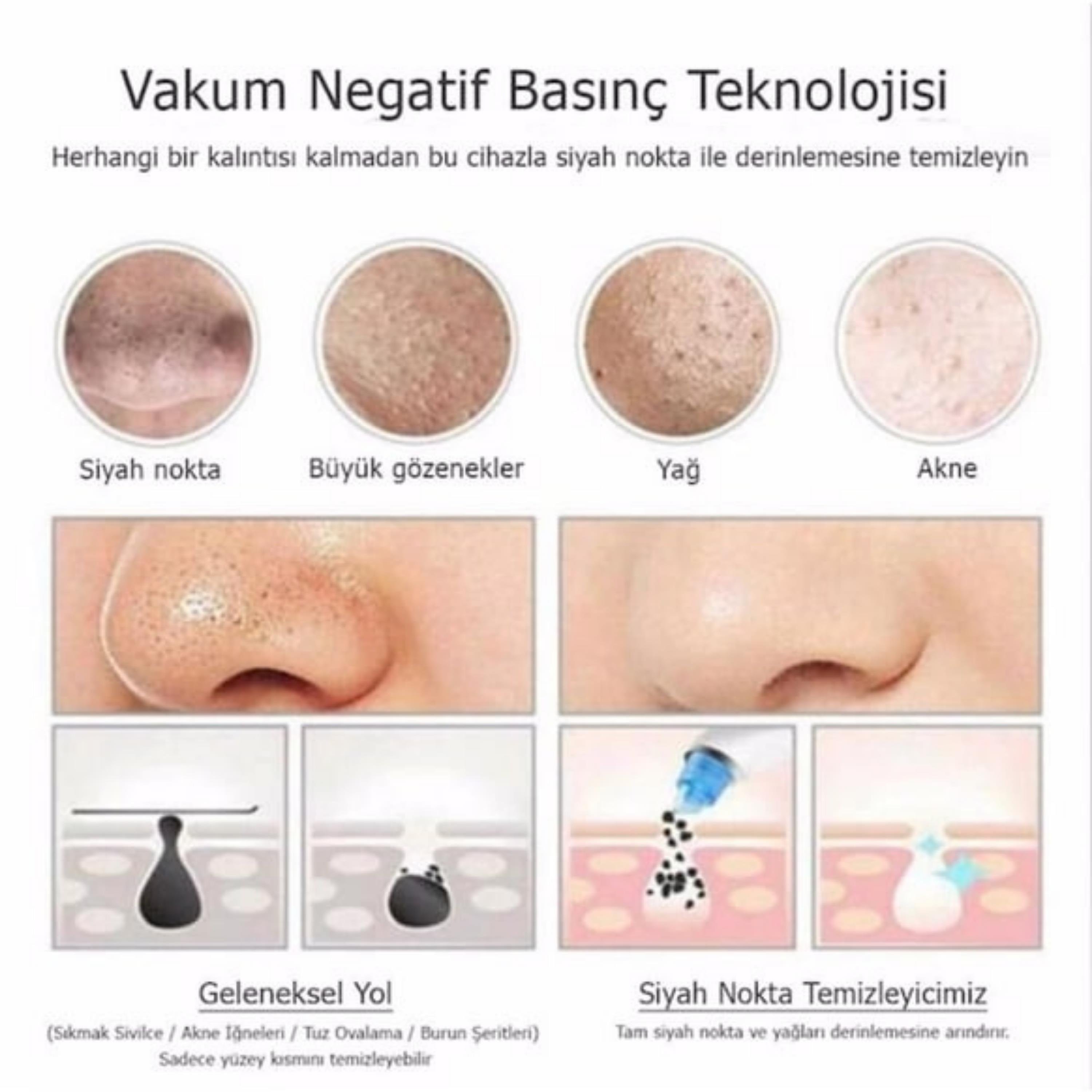 Vakumlu Siyah Nokta Ve Yüz Temizleme Cihazı