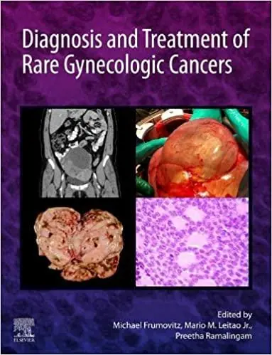 Diagnosis and Treatment of Rare Gynecologic Cancers - 9780323829380