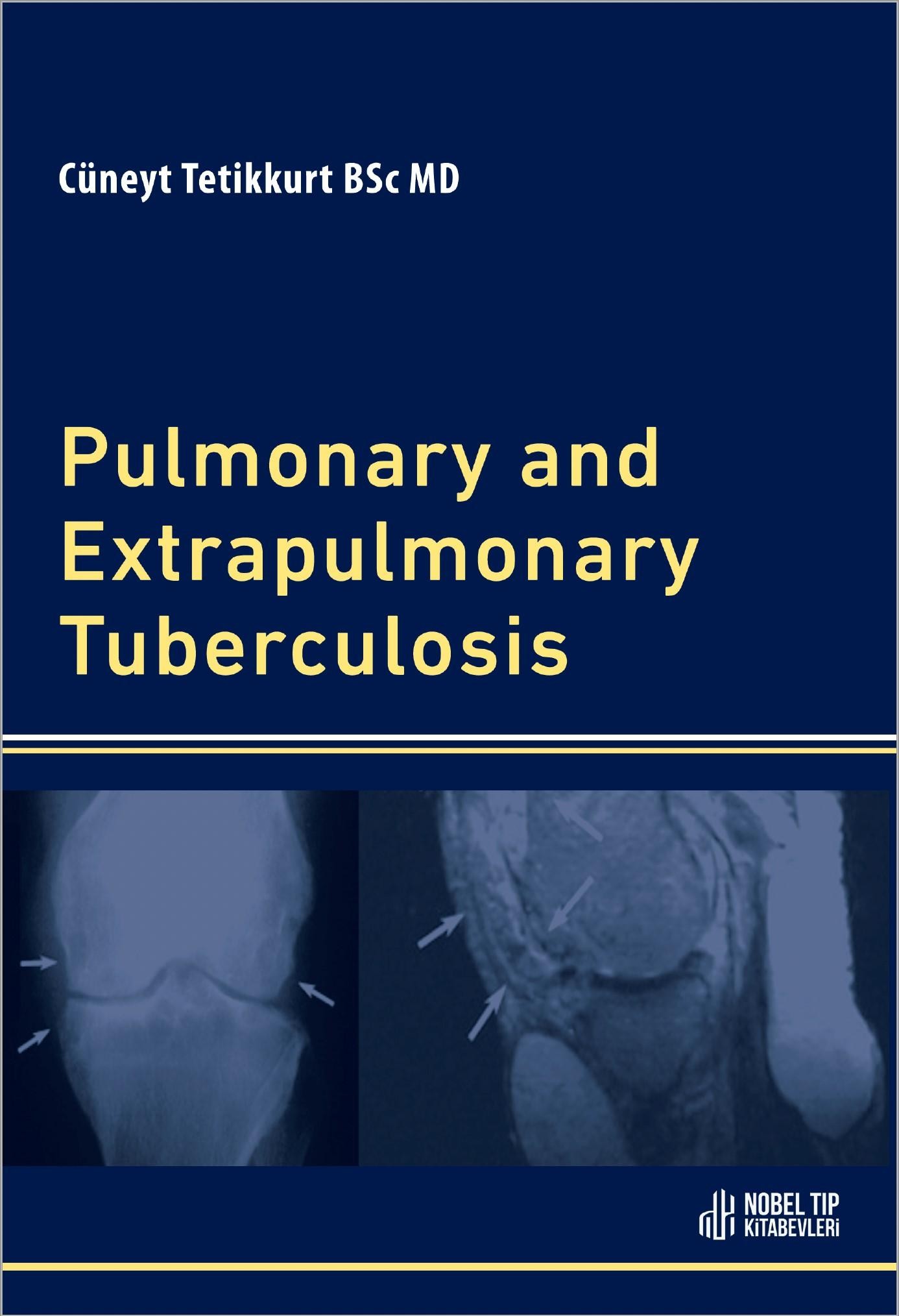 Pulmonary and Extrapulmonary Tuberculosis