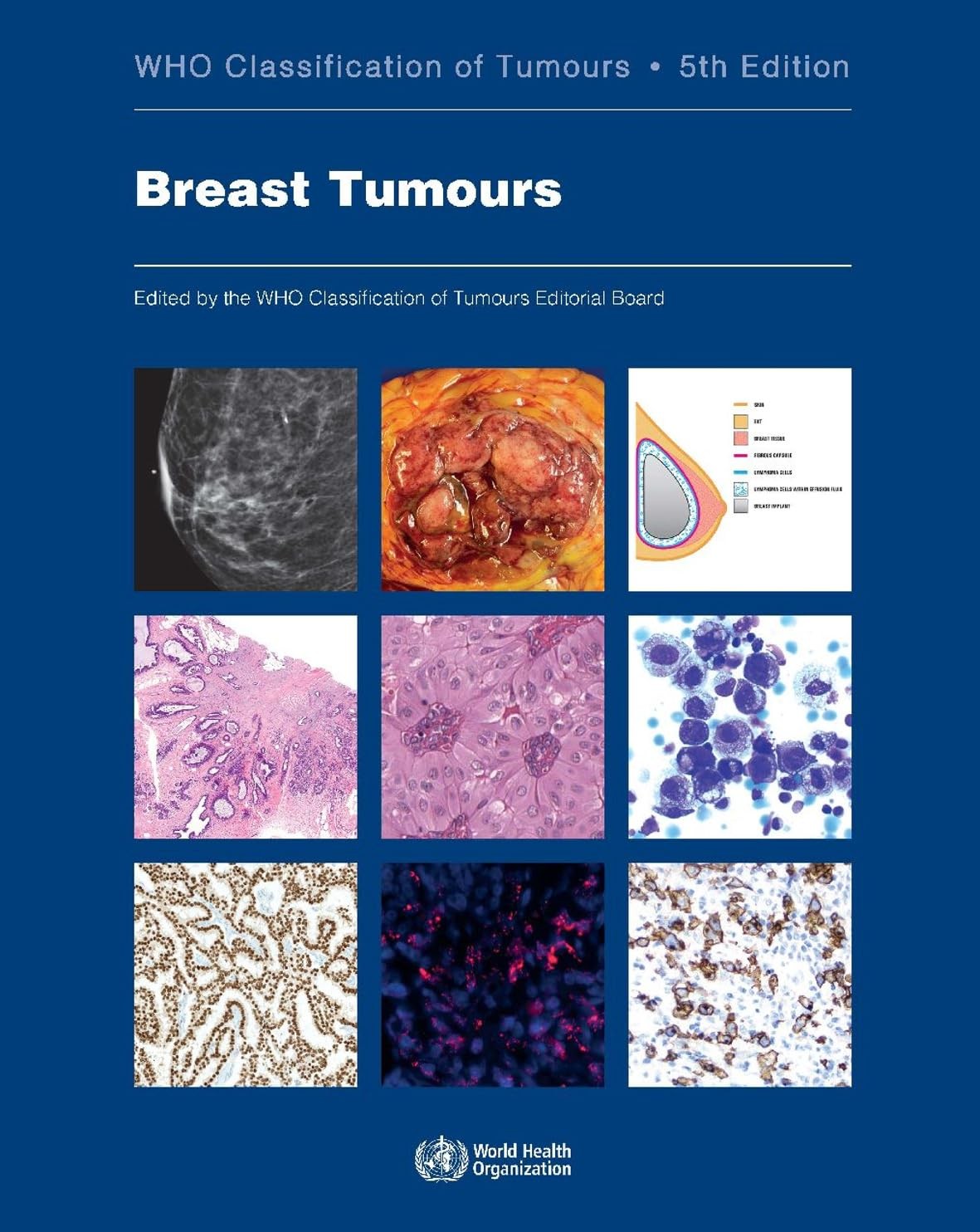 Breast Tumours WHO Classification of Tumours, 5th