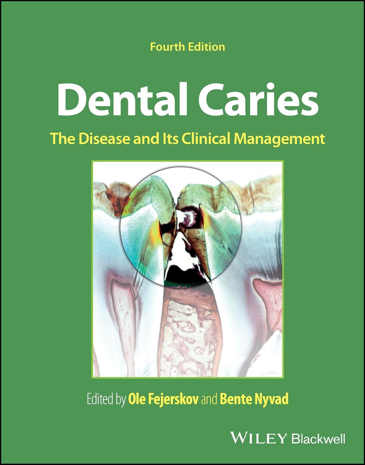 Dental Caries: The Disease and its Clinical Management,4th Edition