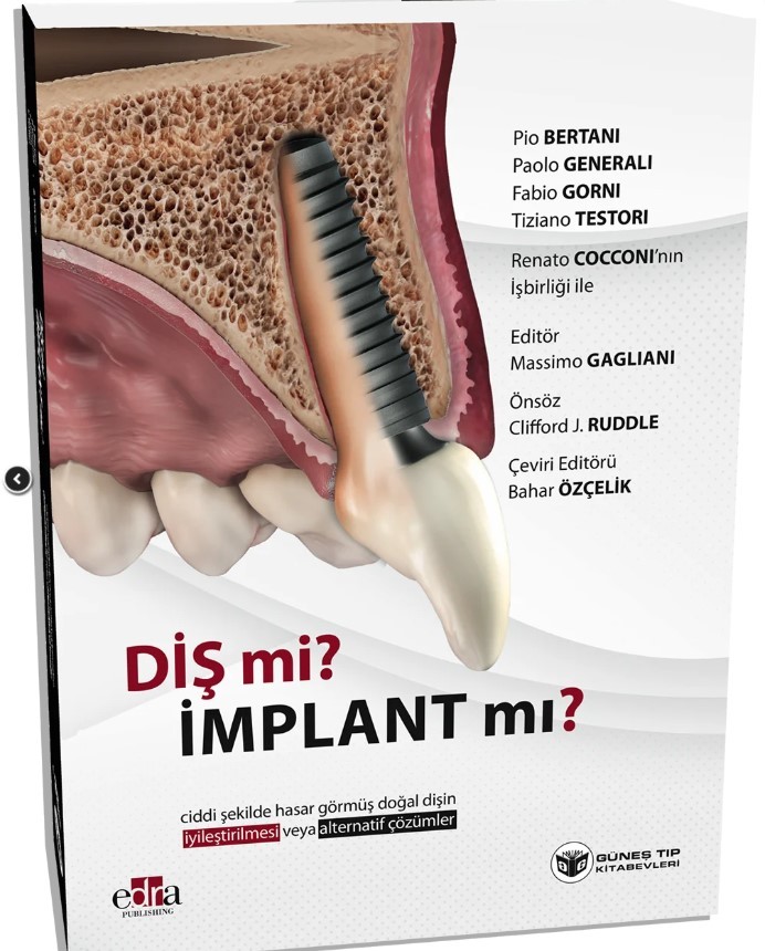 Diş mi? İmplant mı? (Doğal Dişin Korunması veya İmplant Çözümleri Üzerine Kapsamlı Rehber)