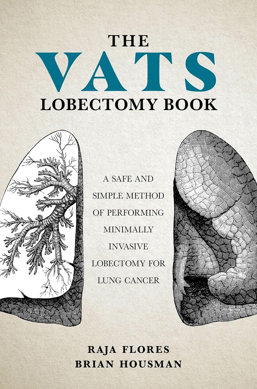 The VATS Lobectomy Book: A Safe and Simple Method of Performing Minimally Invasive Lobectomy for Lung Cancer