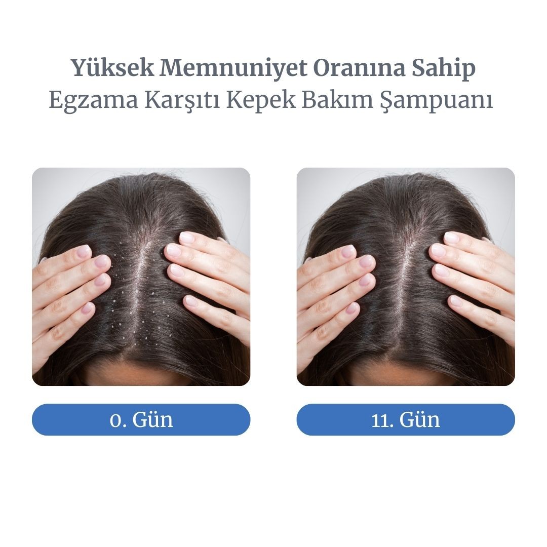 Relief-1 Shampoo Egzama Kaynaklı Kepek Karşıtı Bakım Şampuanı