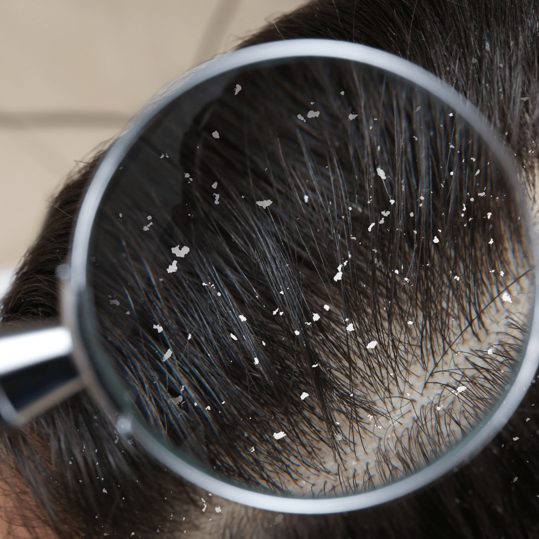 Saç Derisi Sağlığı: Kepek Hakkında Bilinmesi Gerekenler ve İzderma Relief Serisi İle Saçlarınıza Özel Bakım