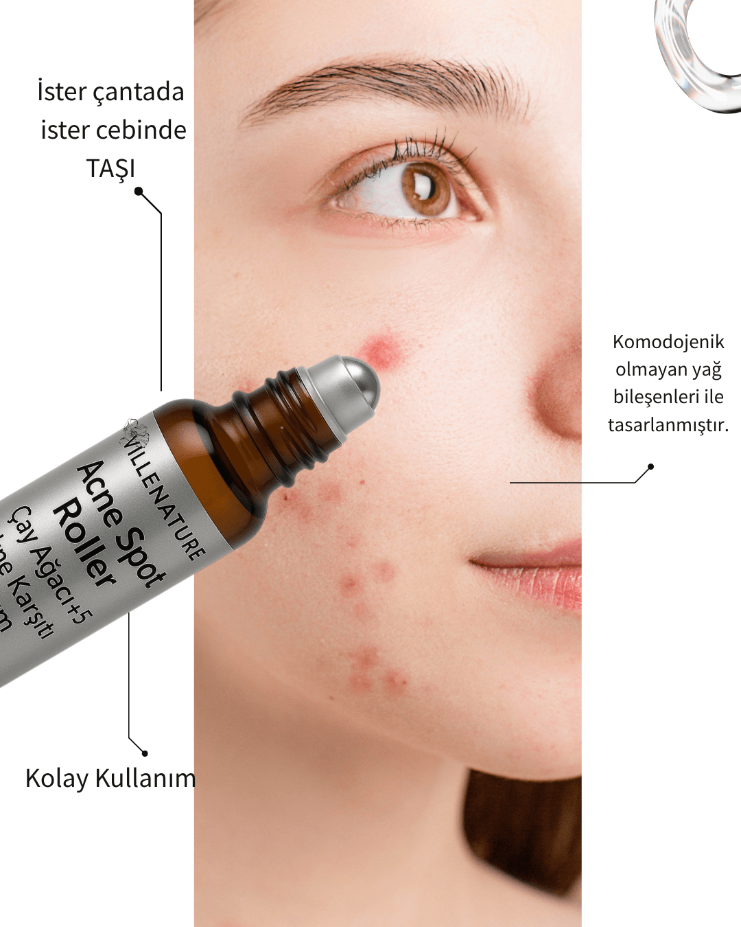 ACNE SPOT