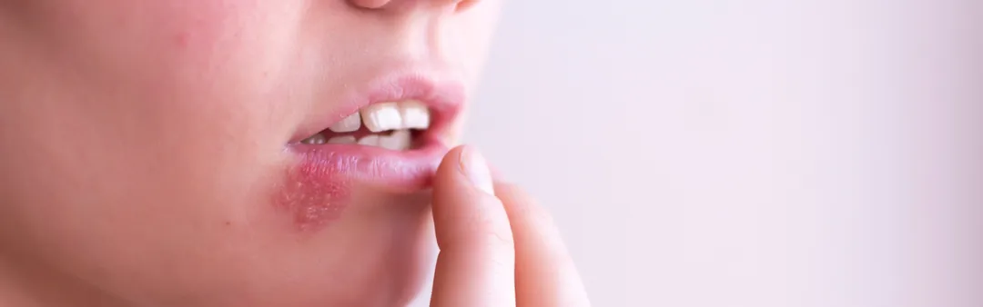 Dudakta HSV ve uçuk