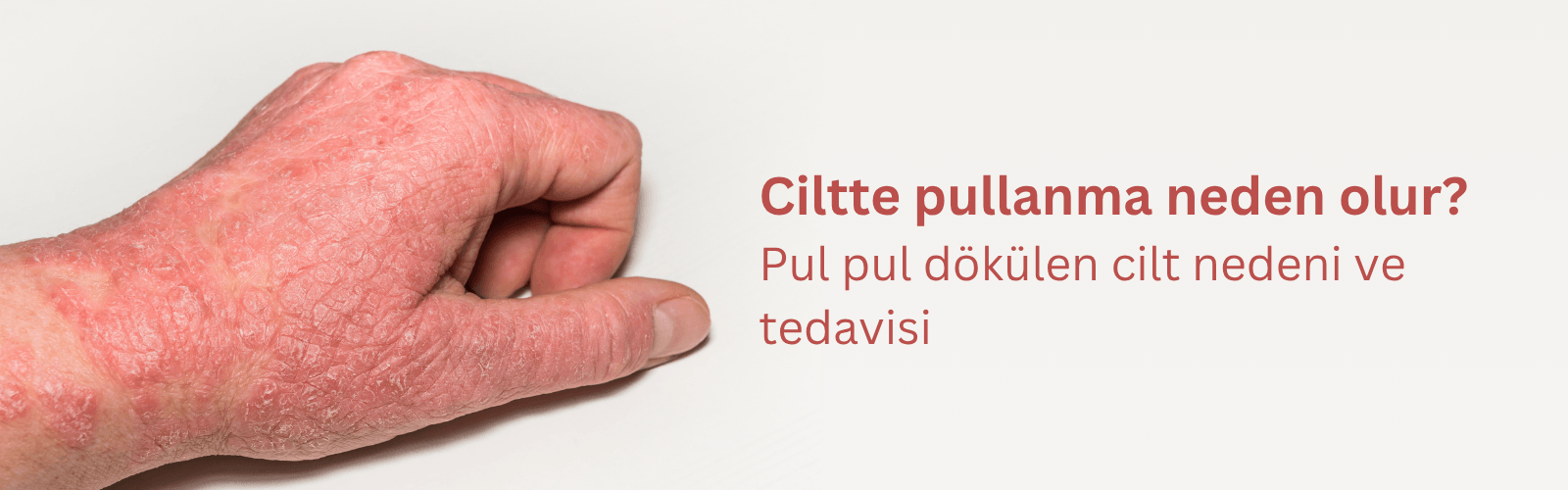Ciltte Kuruluk, Pullanma ve Dökülme Neden Olur?