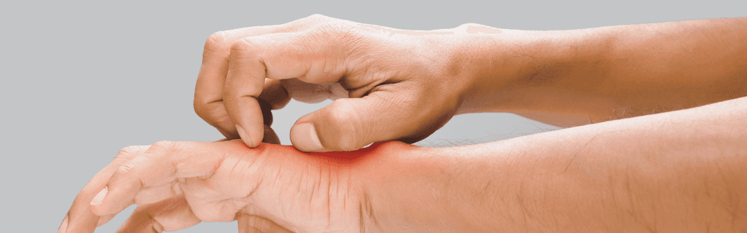 Cilt kaşıntısının nedenleri arasında egzama ve seboreik dermatit sıkça görülür.