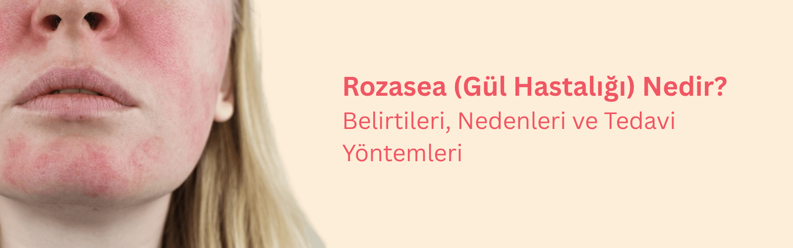 Gül Hastalığı (Rozasea) Nedir? Neden Olur? Nasıl Geçer? 