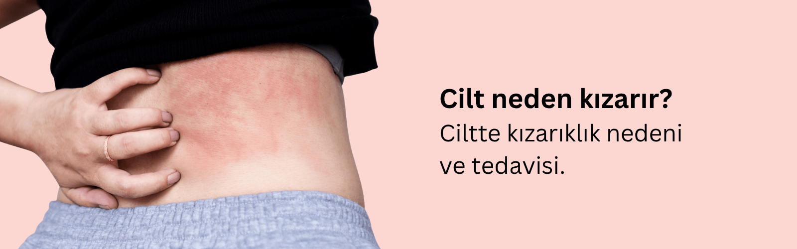 Ciltte Kızarıklık Neden Olur? Yüzde Kızarıklık Neden Olur? Deride Kabartı, Kızarıklık ve Kaşıntı Nedenleri