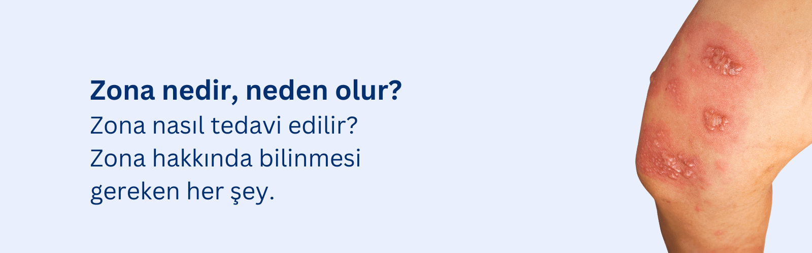 Zona Hastalığı Nedir? Zona Neden Olur?
