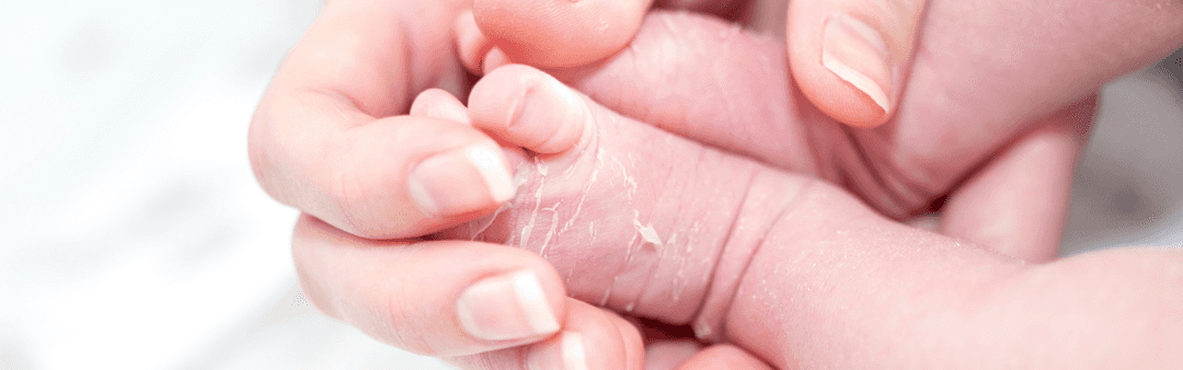 Bebeklerde pullanarak dökülme görülebilir.