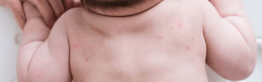 Bebeklerde sıkça kızarıklık görülür.