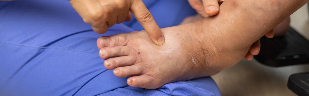 Ayakta ve bilekte ödem