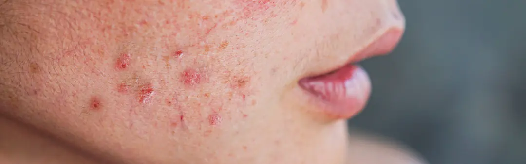 Sivilceli cilt görünümü