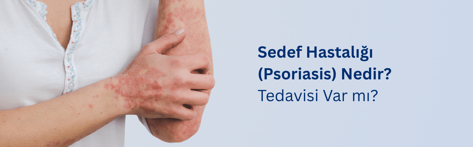 Sedef Hastalığı (psoriasis) Nedir? Tedavisi var mı?