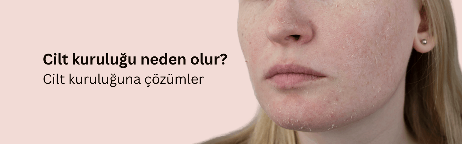 Kuru Cilt Nedir? Cilt Kuruluğu Neden Olur? Cilt Kuruluğuna Ne İyi Gelir?