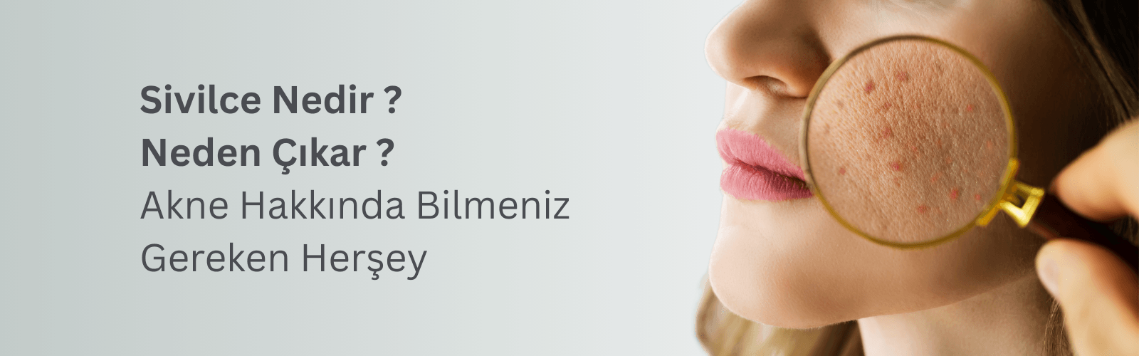 Sivilce Nedir, Neden Çıkar? Akne Hakkında Bilmeniz Gerekenler