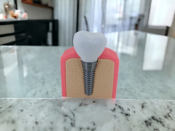 Dental Tasarım Diş Implant  Sunum Maket Hediye