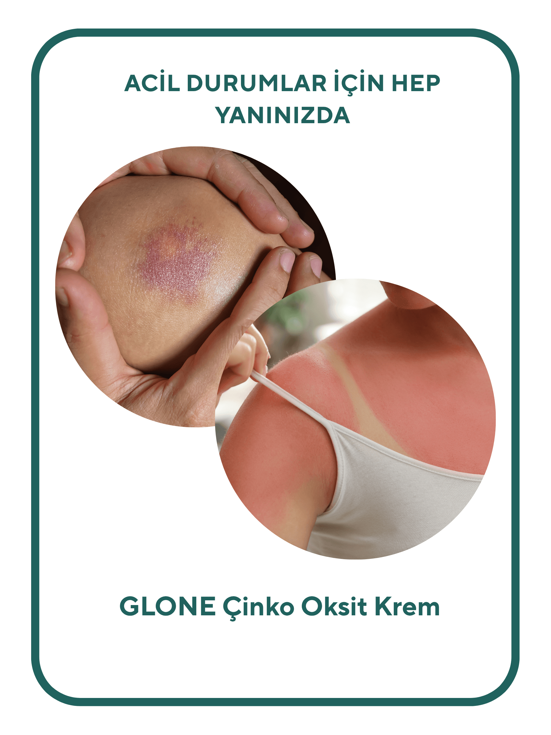 GLONE Çinko Oksit Krem | Panthenol, Lanolin & Allantoin İçeren Hassas Cilt ve Pişik Önleyici Krem | Doğal Bariyer Koruma & Nemlendirme