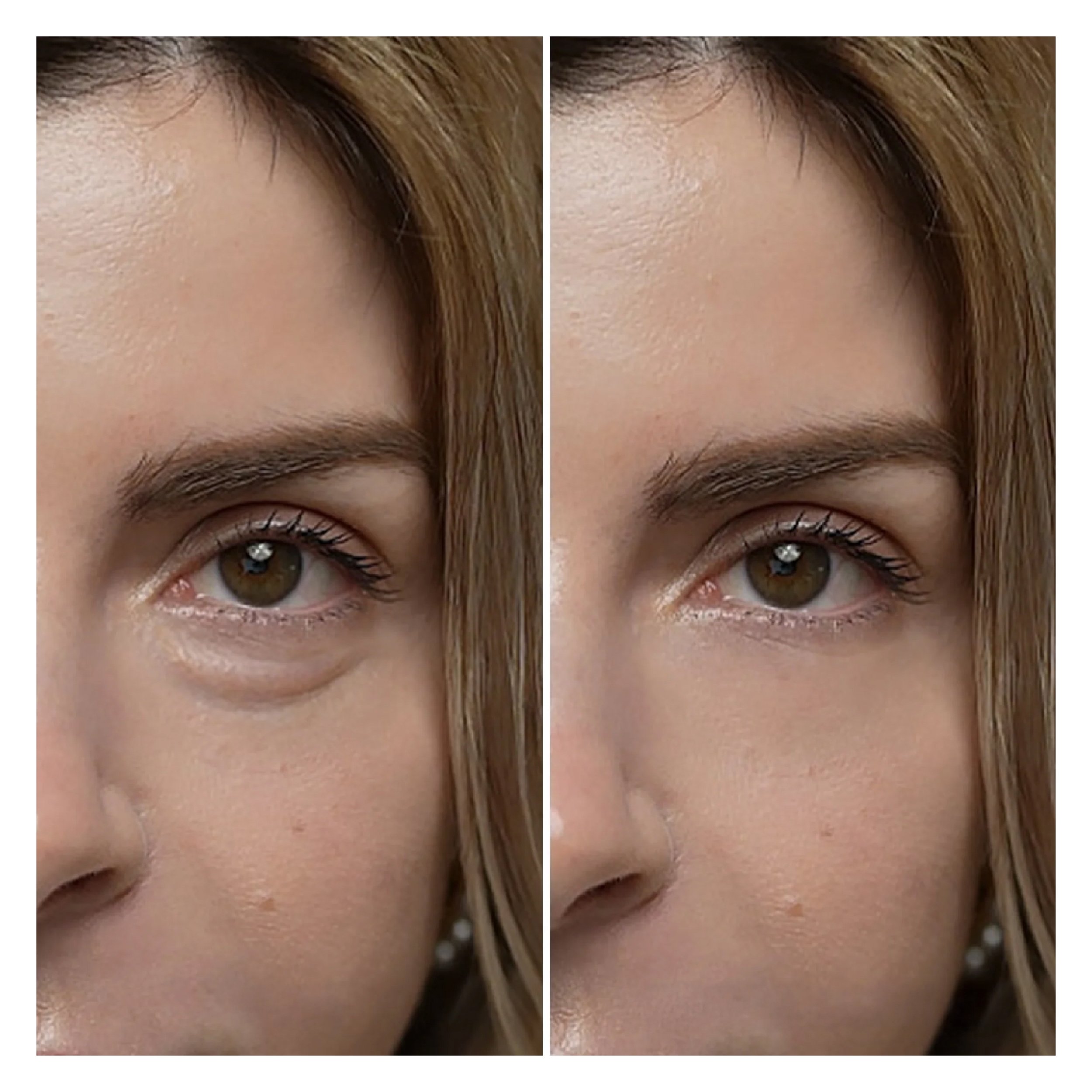 Eyephalt Retinollü Göz Altı Bakım Kremi Bio-Spicule Teknolojili 10ml