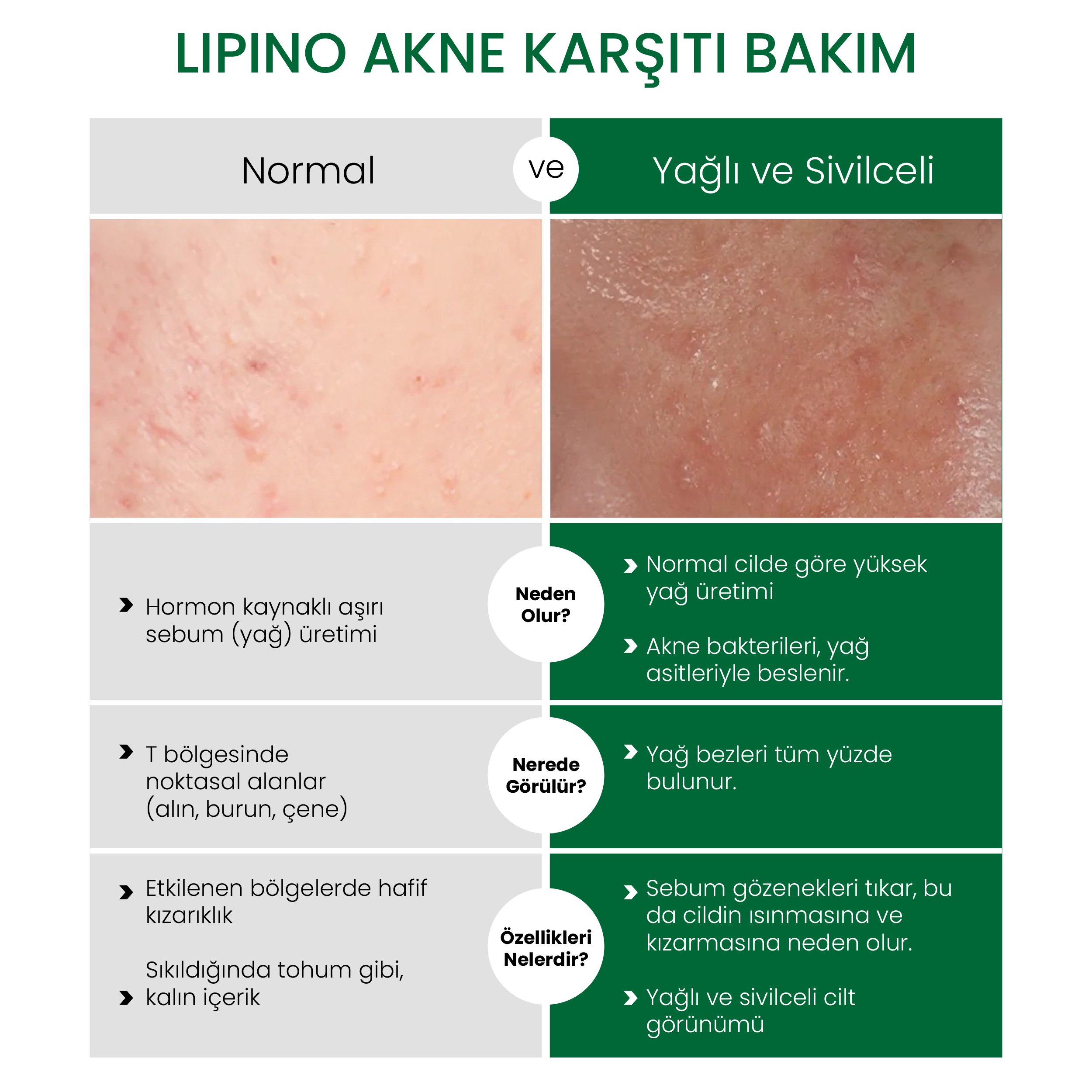 Lipino Sivilce Ve Yağlanma Karşıtı Ampul 30ml