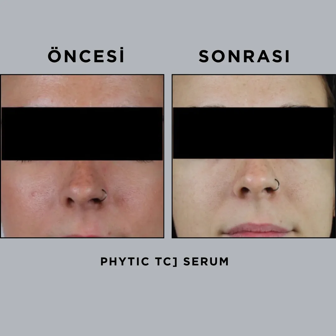 PHYTIC [TC] SERUM 30 ml