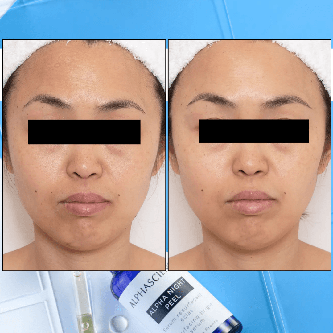 ALPHA NIGHT PEEL
