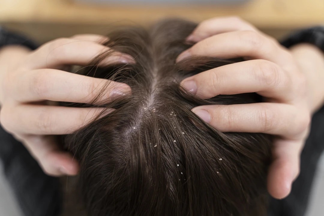 What is Good for Dandruff?