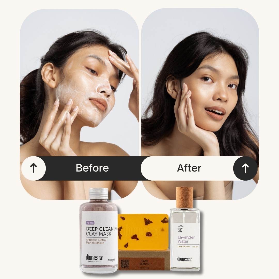 Acne Relief Set