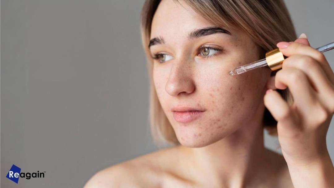 Sivilce İçin Hangi Serum Tercih Edilmeli?