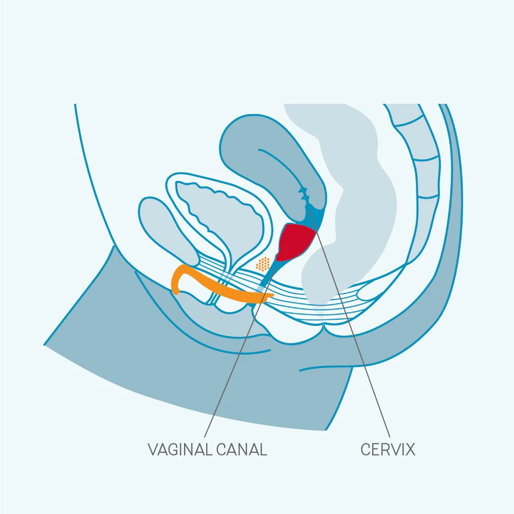 Regl kabının vajina kanalındaki yerleşimi