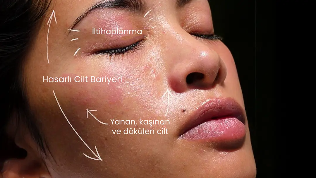 Bariyer hasarlı cilt