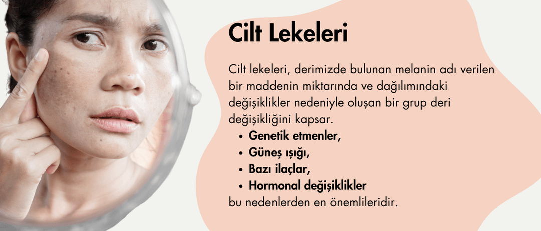 Cilt Lekeleri