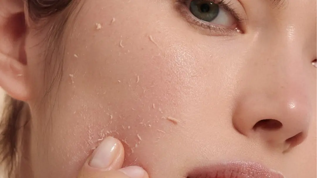 Peeling Nedir?