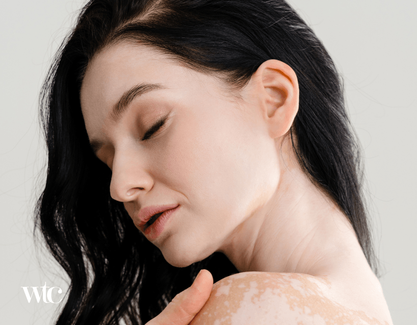 Cilt Lekeleri ve Doğru Ürün Seçimi